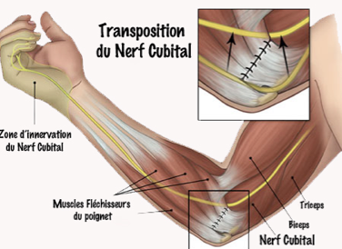 la compression du nerf ulnaire ( ou cubital) est responsable de ...